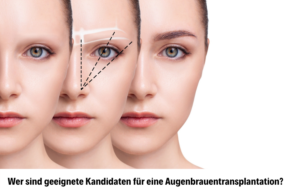 Augenbrauentransplantation